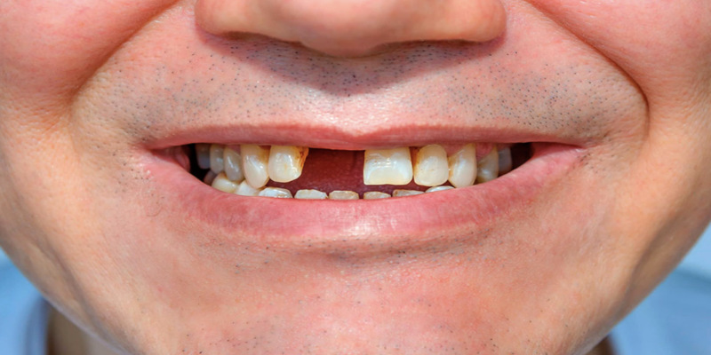 Ngủ mơ gãy răng đánh con gì chuẩn nhất? 